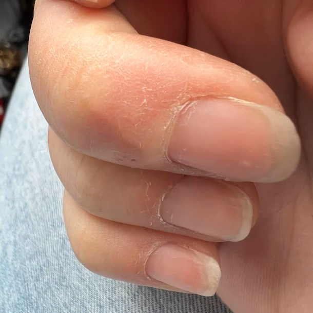 Hoe ziet een allergische reactie op acrylverf eruit?