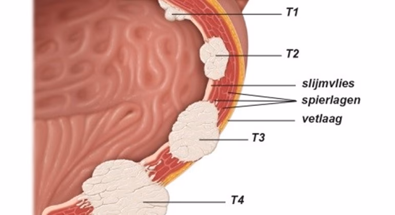 Wat zijn de eerste symptomen van blaaskanker?