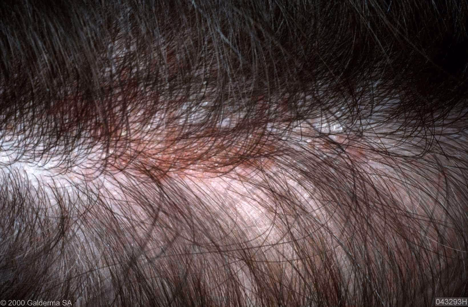 Kan haarverf blaren veroorzaken?