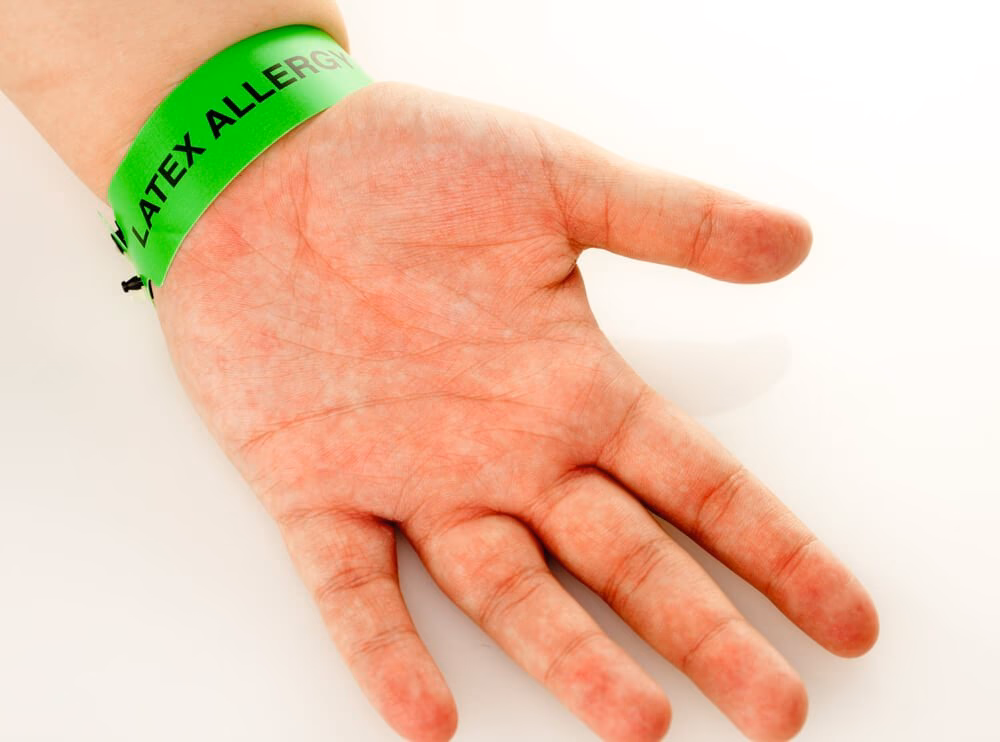 Hoe weet je of je niet tegen latex kunt?