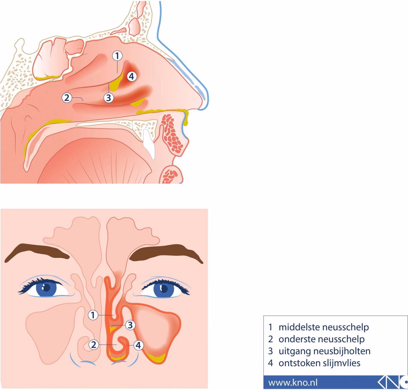 Wat zijn de symptomen van een beschadigd neusslijmvlies?