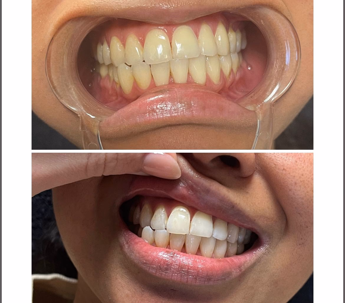 Is het veilig om mijn tanden te bleken met peroxide?